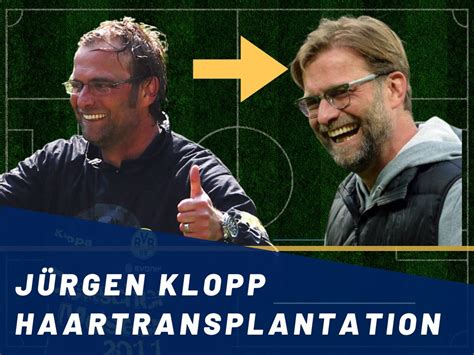 Jürgen Klopp Haartransplantation Haarausfall Technische Analyse