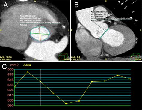 Aortic Annulus Measurement