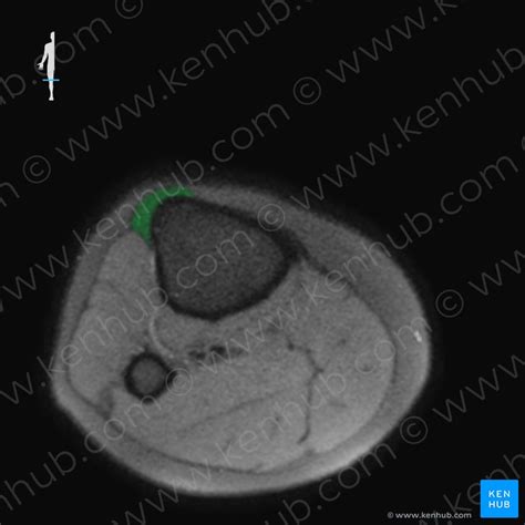 Ligamentum Patellae