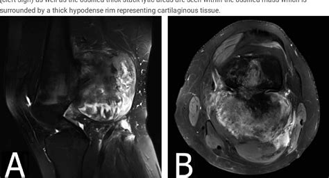 Figure From Hemicortical Resection And Biological Reconstruction