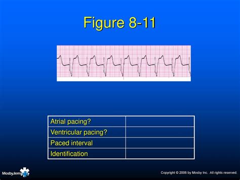 Ventricular Paced Rhythm