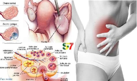 Sant Voici Les Signes Dangereux De Kyste Ovarien Et Comment Le