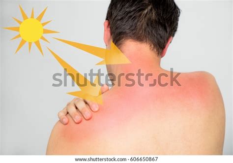 Young Man Bad Sunburn On His Foto Stock 606650867 Shutterstock