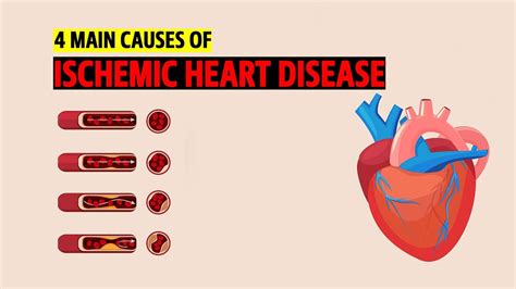 Main Causes Of Ischemic Heart Disease Youtube