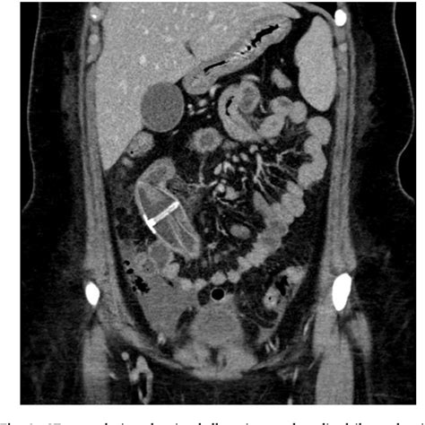 Figure 2 From Small Bowel Obstruction Secondary To Gastric Balloon