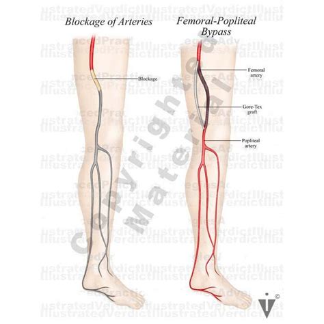 Stock Lower Limb Bypass Of Vasculature Illustrated Verdict