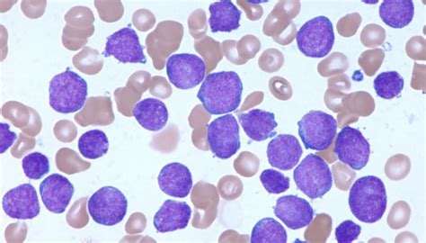 Acute Leukemia Treatment Procedure Description Mymeditravel Knowledge