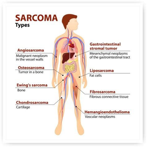 Sarcoma - LAKESHORE CANCER CENTER