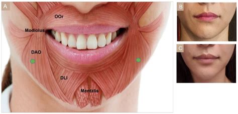 Toxins Free Full Text Cosmetic Treatment Using Botulinum Toxin In The Oral And Maxillofacial