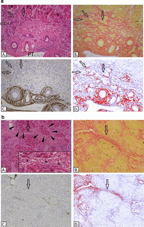 A Submassive Hepatic Necrosis A Hande A Portal Tract Pt Is Shown Download Scientific