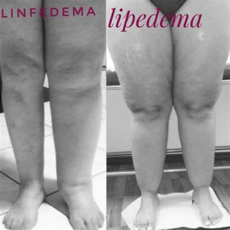 Linfoscintigrafia Archivi State Of Lymphedema