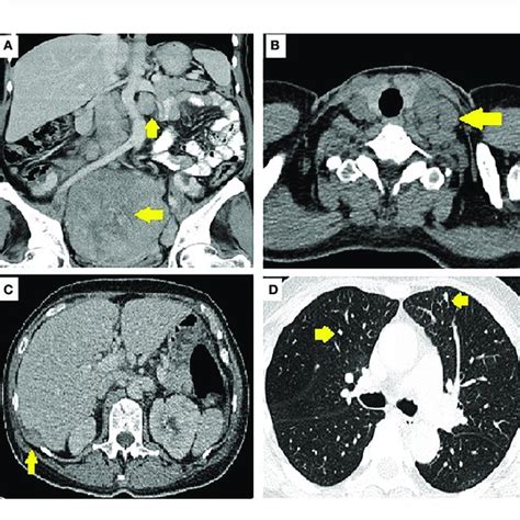 Image Of Pelvic Tumor And Metastasis A Para Aortic Lymph Nodes And Download Scientific