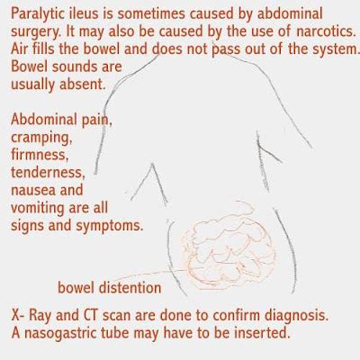 Dear Nurses: PARALYTIC ILEUS