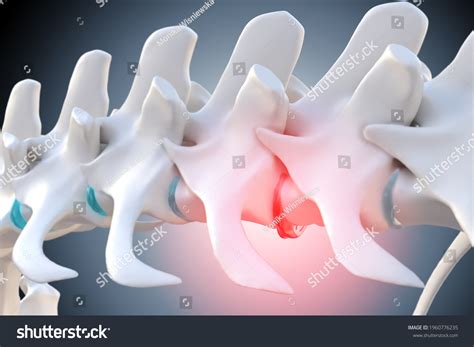 3d Illustration Degenerated Prolapsed Intervertebral Disc ภาพประกอบ