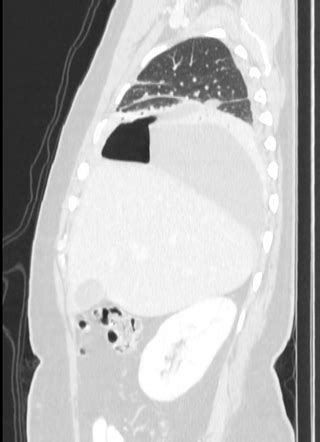 Esophageal Perforation Image Radiopaedia Org