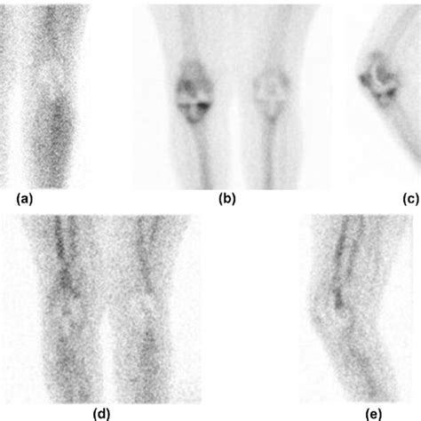 Aseptic Loosening Pattern I Aec Bone Scintigraphy A Early