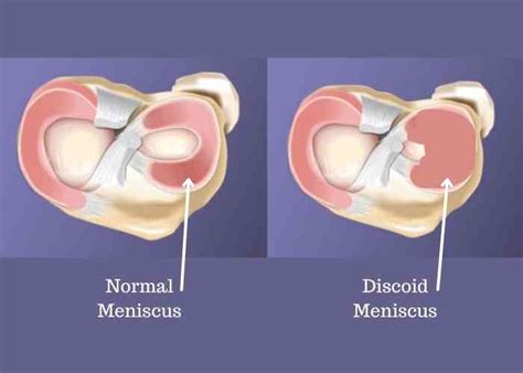 Discoid Meniscus Repair Discoid Meniscus Reconstruction Orthopedic