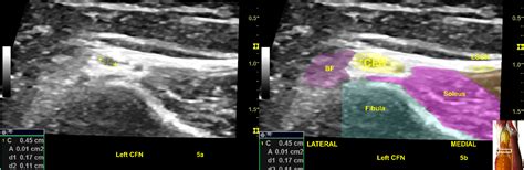 Figure 5 From Ultrasound Guided Nerve Hydrodissection For Pain Management Rationale Methods