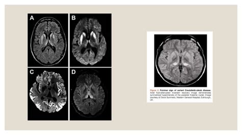 Creutzfeldt Jakob Disease PPT