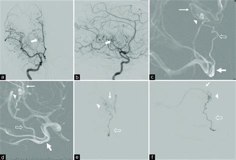 A And B Right Internal Carotid Artery Angiography In Frontal And Download Scientific Diagram