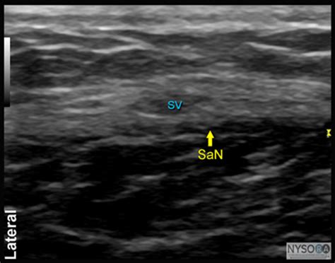 Ultrasound-Guided Saphenous Nerve Block - NYSORA The New York School of Regional Anesthesia