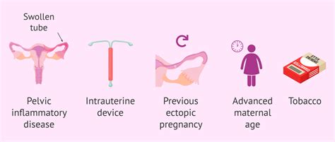 Risk Factors For Ectopic Pregnancy