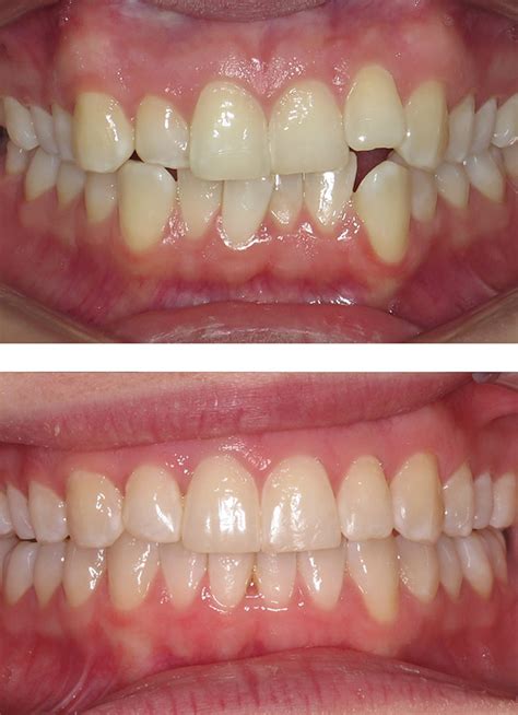 Invisalign Clear Braces Treatment Cleveland Orthodontics In Middlesbrough