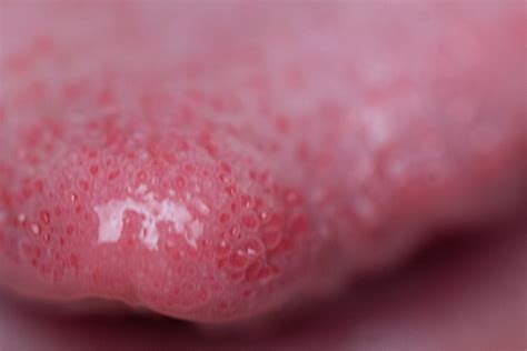 Lingua A Fragola Nei Bambini Cause Principali E Cosa Fare