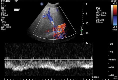 Splenic Vein Doppler Ultrasound