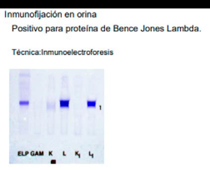 Se observa una inmunofijación en orina positiva para cadenas livianas