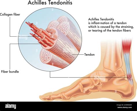 Achilles tendon tear Stock Vector Images - Alamy