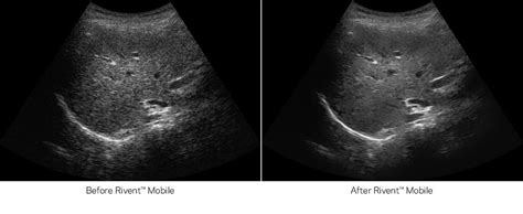 Rivent Riventmobile Ultrasound Ultrasoundinnovation Medicalimaging