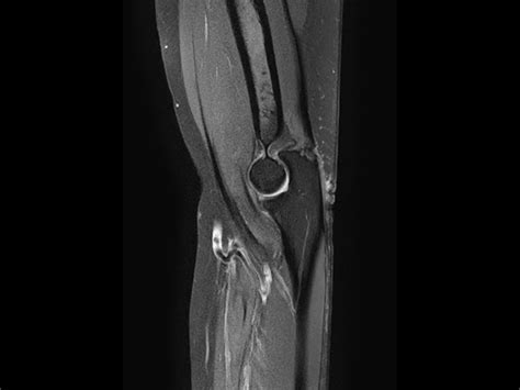 Large Fov Imaging With The Ds 16ch Small Extremity Coil Philips Mr