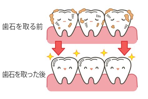 歯石取りはどのくらいの頻度で受ければいいの？｜茨木クローバー歯科 よくあるご質問