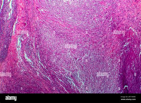 Hodgkins Lymphoma Light Micrograph Photo Under Microscope Stock