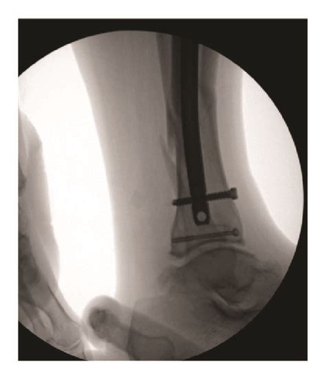 Intraoperative Fluoroscopy Images Following Tibial Rodding And