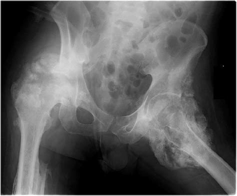 The Hip Joint X Ray Image Demonstrates The Hip Joint Heterotopic Download Scientific Diagram