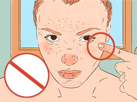 3 Ways To Be Confident If You Have Acne Wikihow