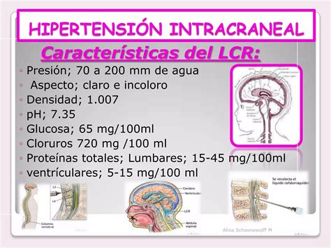 S Ndrome De Hipertensi N Endocraneana Ppt