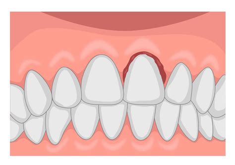 What Is Subluxation Of Tooth News Dentagama