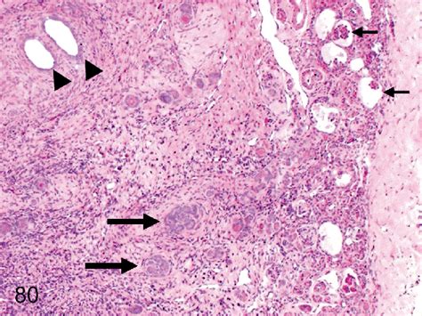 Kidney: Renal dysplasia. A typical lesion of renal dysplasia consists ...