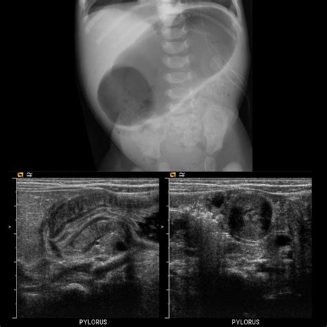 Infant with projectile vomiting, weight loss and severe dehydration | Pediatric Radiology Case ...