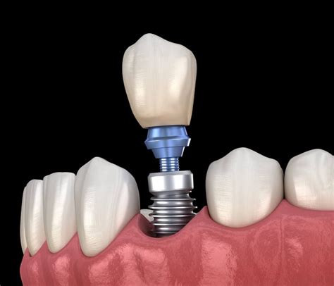 Dental Implant Prosthetics Costa Mesa Ca Replace Lost Teeth