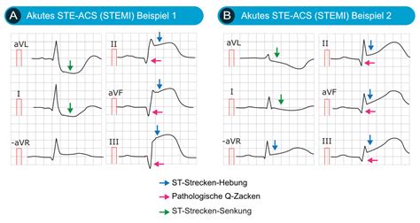 St Hebung Bei Akuter Myokardischämie Und Differentialdiagnosen Ekg And Echo