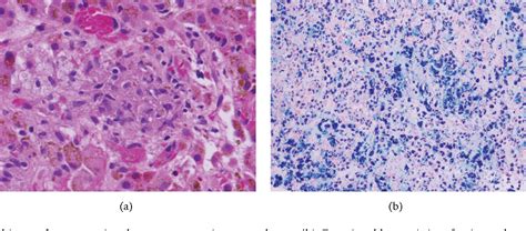 Figure 1 from Mycobacterium avium Complex Infection in a Patient with ...