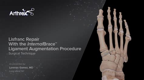 Arthrex Lisfranc Repair With The Internalbrace Ligament Augmentation