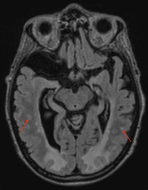 Fluid Attenuated Inversion Recovery Flair Sequence Mri Brain Download Scientific Diagram