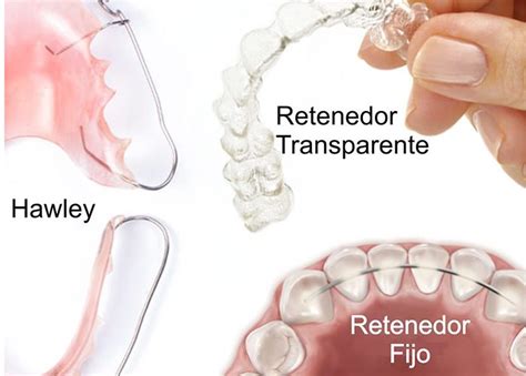 Usando Retenedores Fijos Y Removibles A La Vez Es Posible Blog