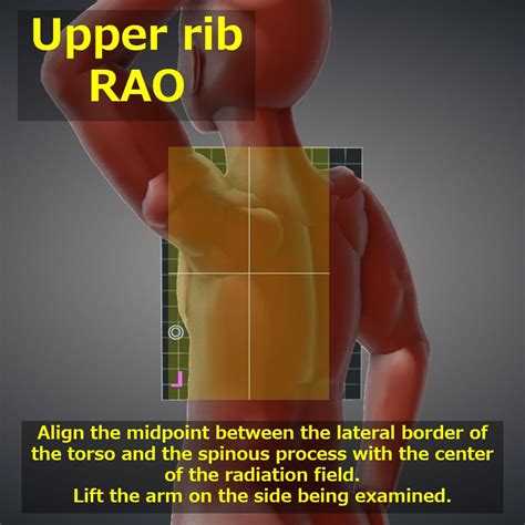 Ribs Oblique View Axillary Ribstools For Radtech