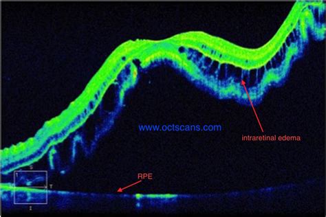 Retinal Detachment - Optical Coherence Tomography Scans